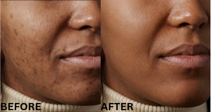 Dark spots Before And After Re-edited