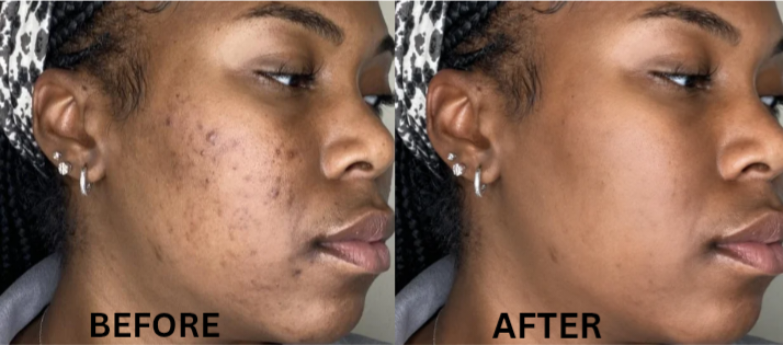 Pimples Before And After Re-edited
